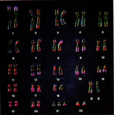 唐氏综合征患者的染色体组成