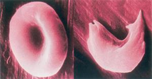 正常红细胞（左）和镰刀型红细胞（右）